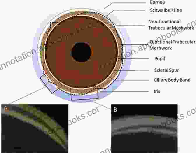 Gonioscopy Diagram Showing The Anterior Chamber Angle And Its Structures Gonioscopy Christoph Faschinger