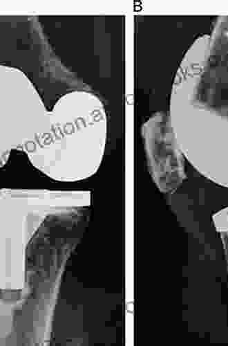 Essentials Of Cemented Knee Arthroplasty